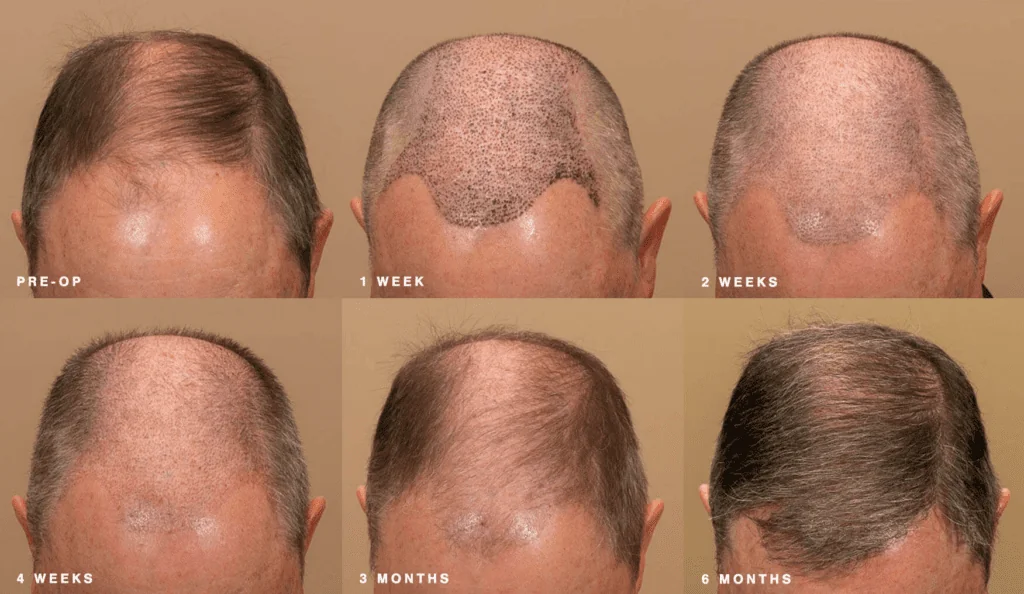 Hair Transplants